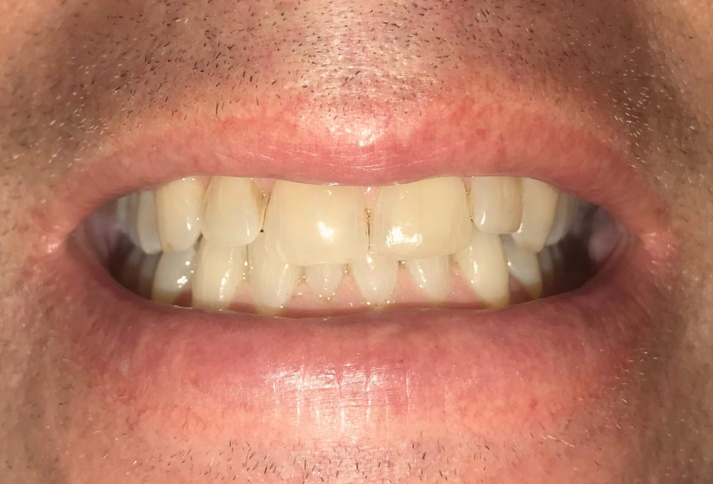 Bedford Man Brighter Smile Before Bedford Man Brighter Smile Before