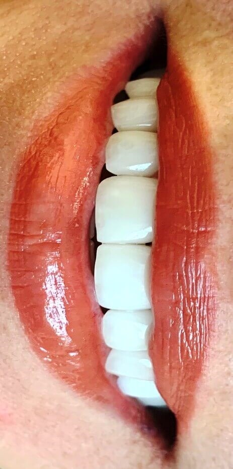 Veneer Before and After Smile After Veneer Before and After Smile After