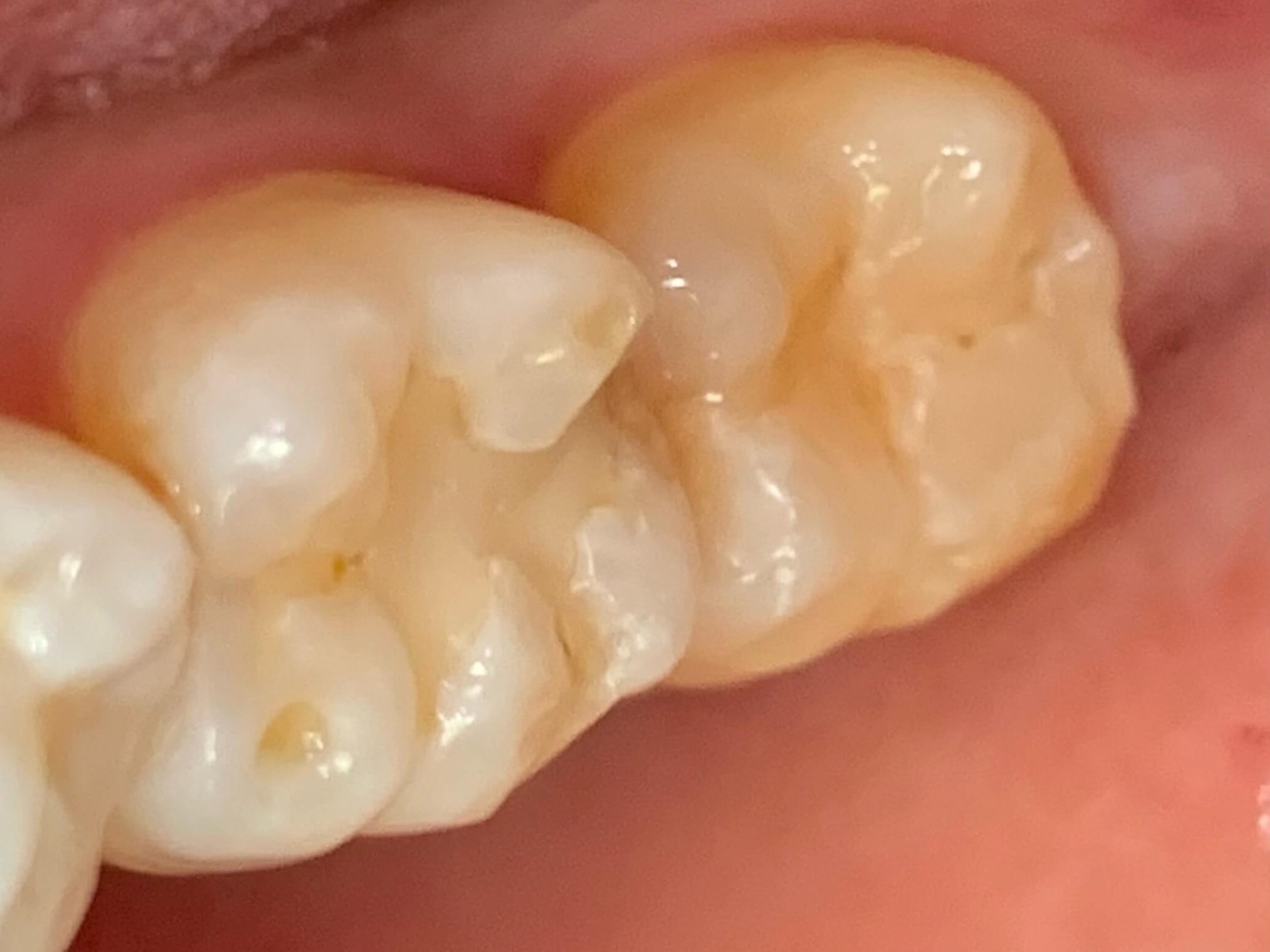 Replacement Composite Fillings Before Replacement Composite Fillings Before