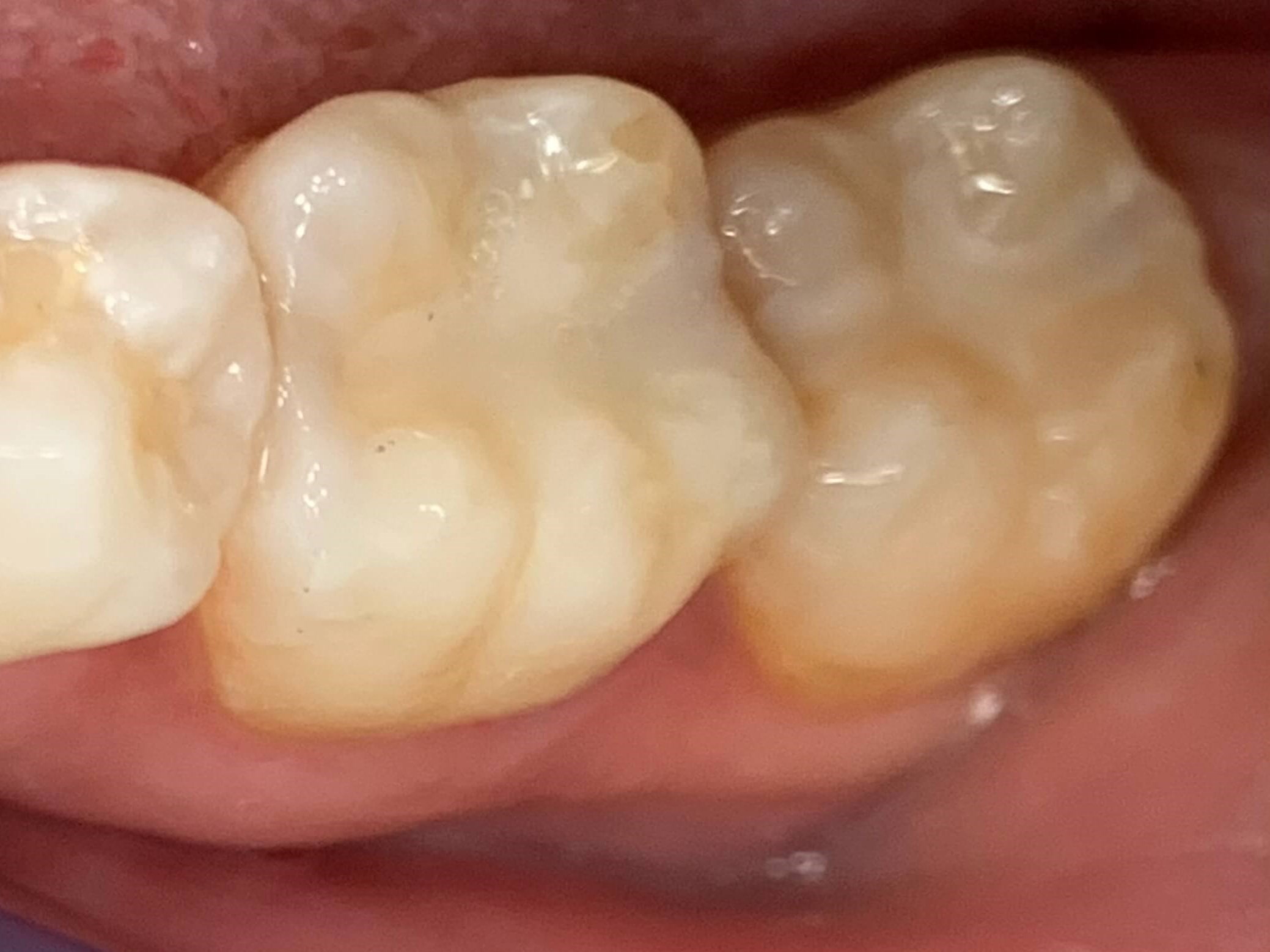 Replacement Composite Fillings After Replacement Composite Fillings After