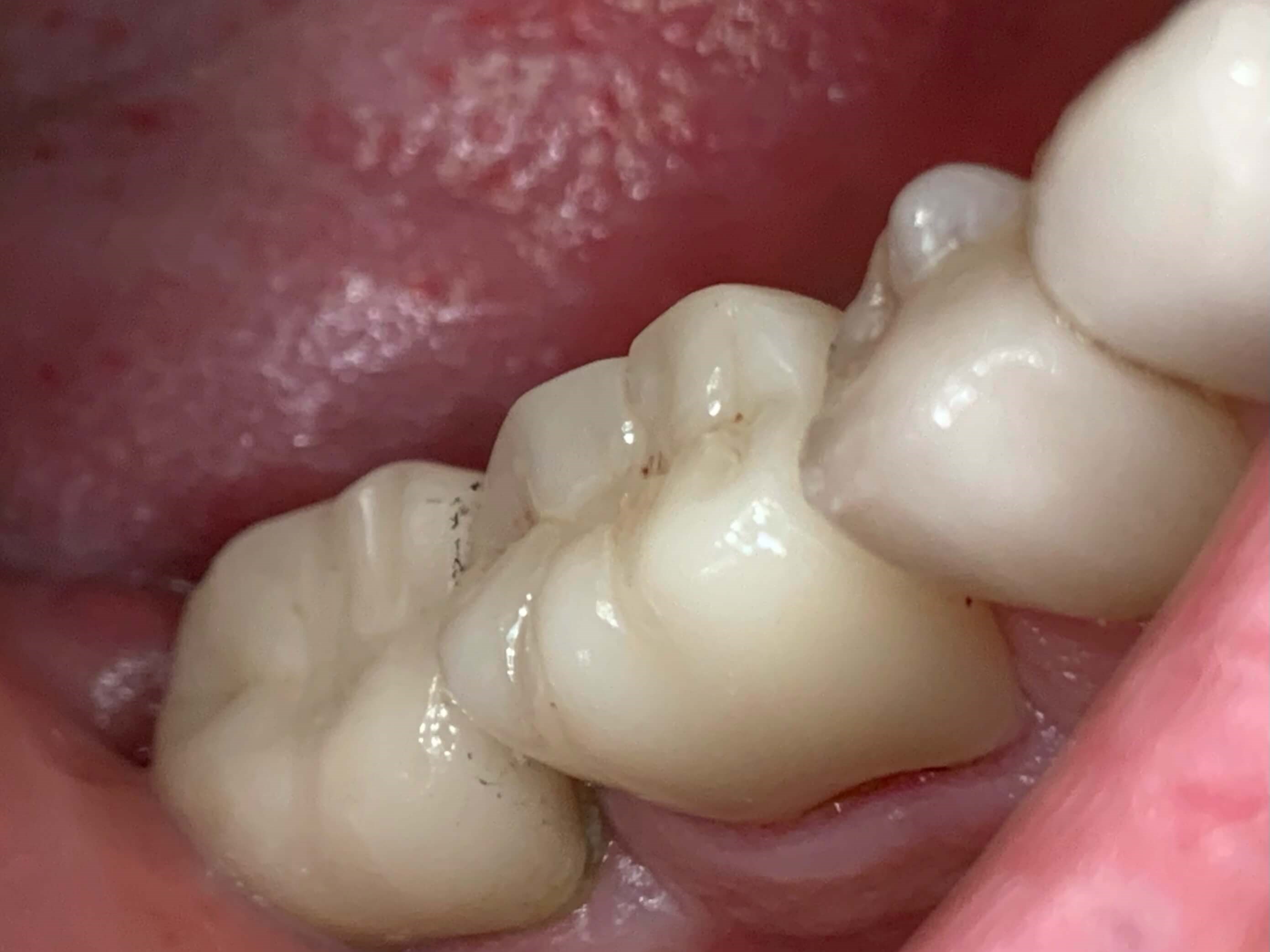 Full Zirconia Crown After Full Zirconia Crown After