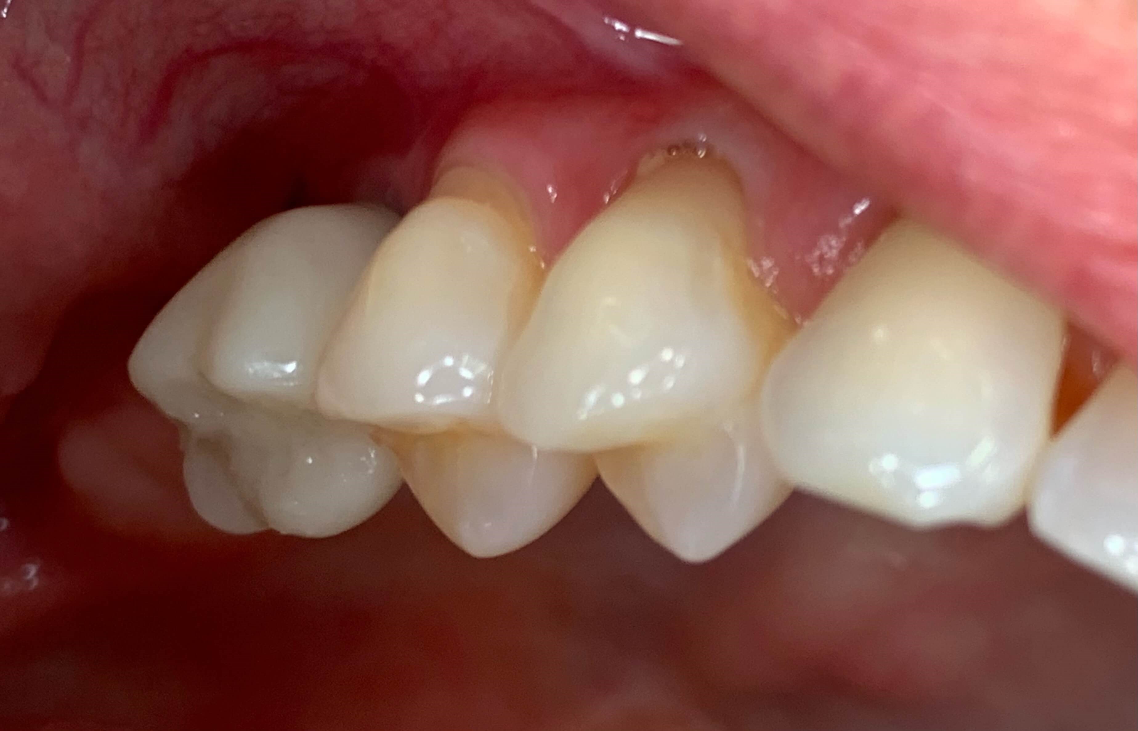 Custom Implant Crown After Custom Implant Crown After