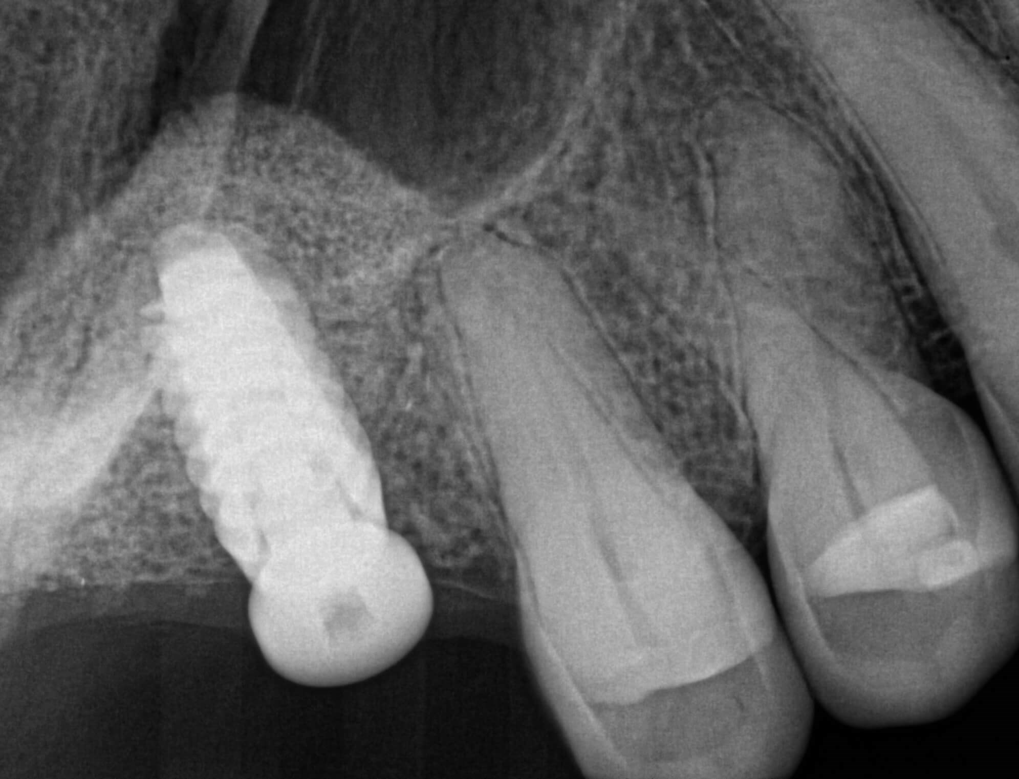 Xrays Before Xrays Before