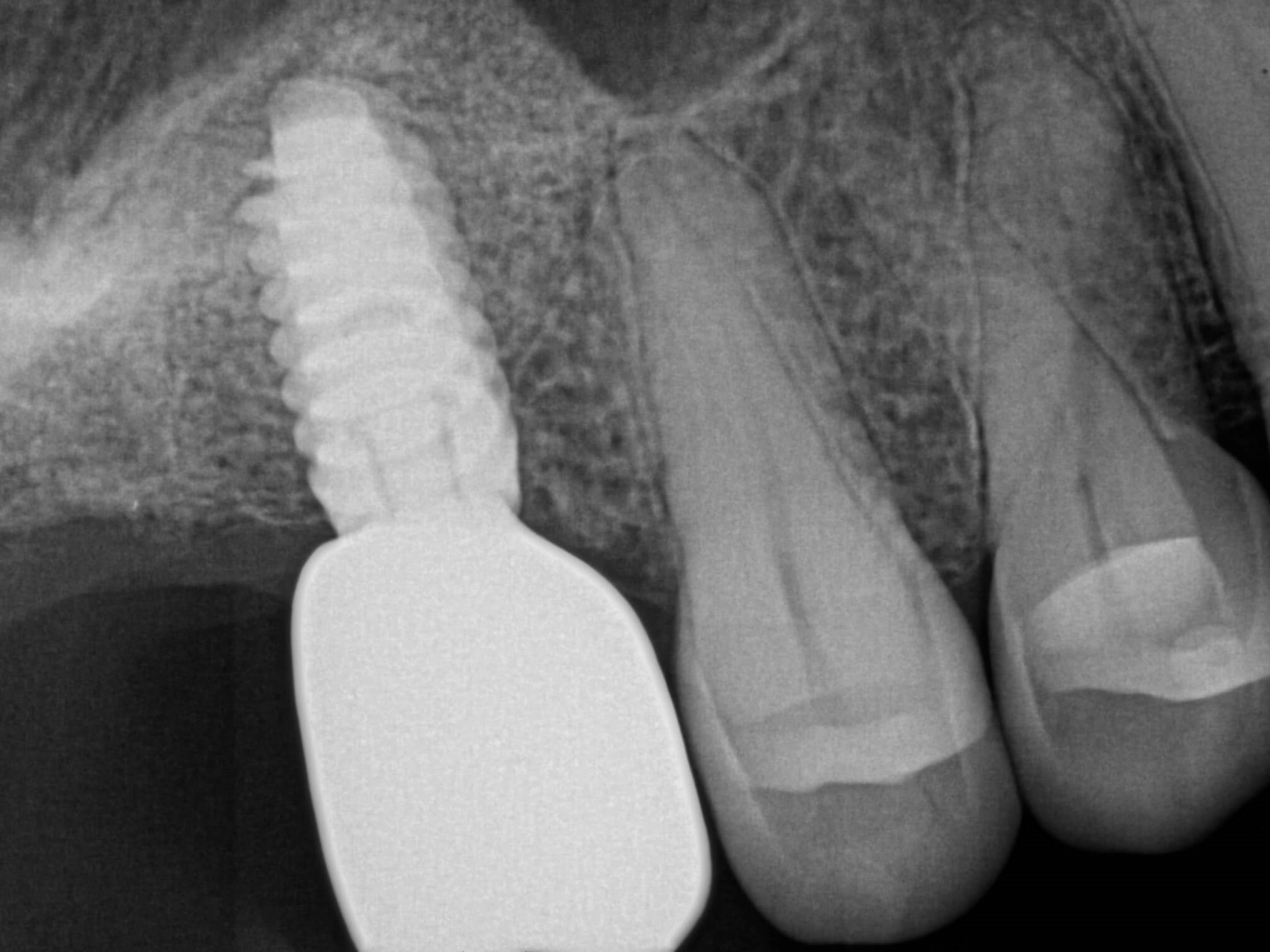 Xrays After Xrays After