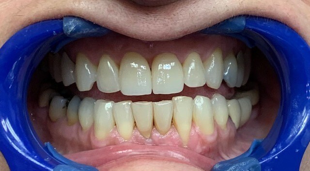 Veneers: Before & After After Veneers: Before & After After