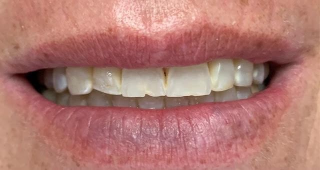 Veneers: Before and After Before Veneers: Before and After Before