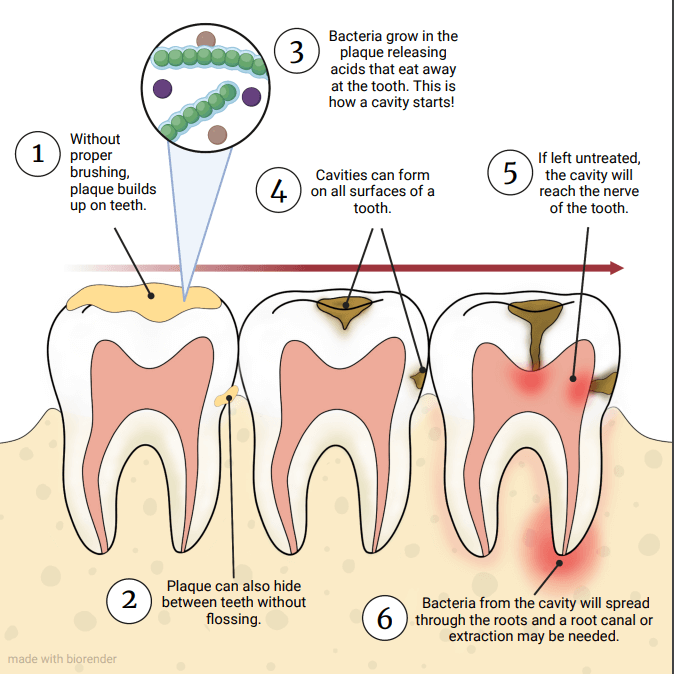 Stages of a Cavity