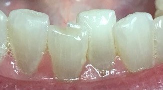 Composite Bonded  Filling Before