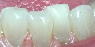 Composite Bonded  Filling After