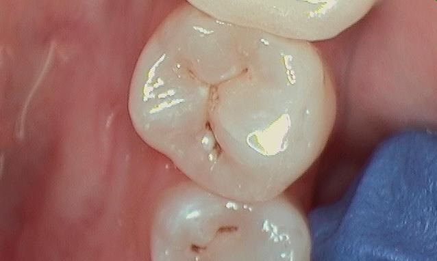 Composite Filling Before