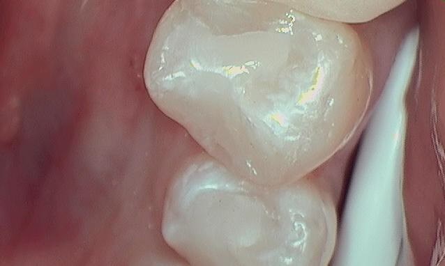 Composite Filling After