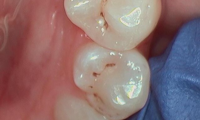 Composite Filling Before