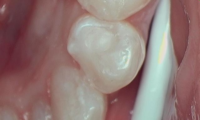 Composite Filling After