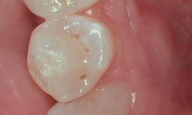 Composite Filling Before