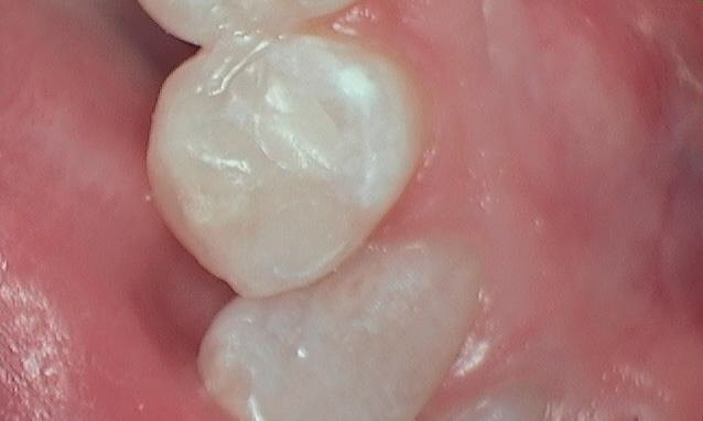 Composite Filling After