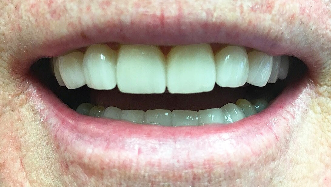 Smile Makeover After