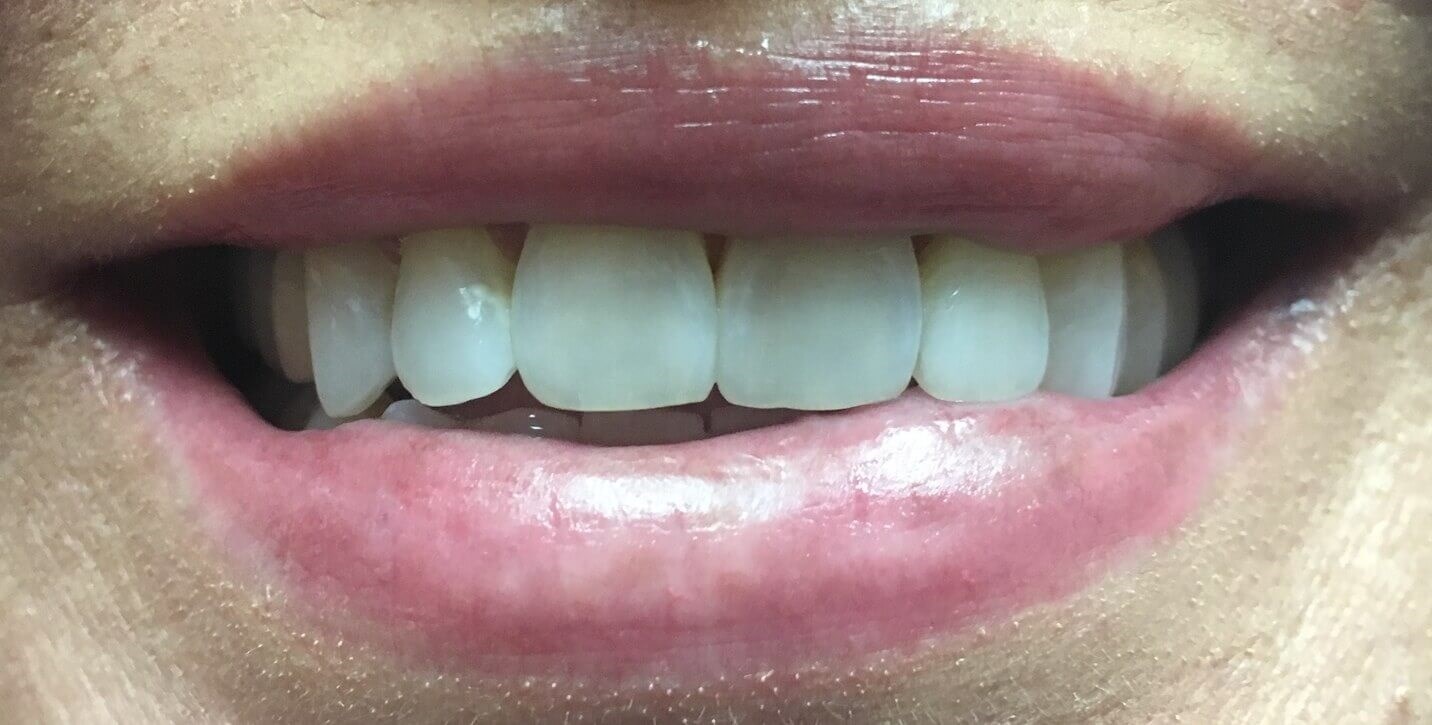 Veneer Before and After Smile Before
