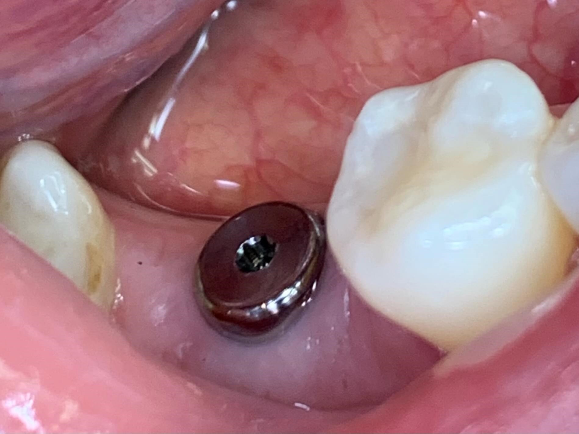 Custom Implant Crown Before