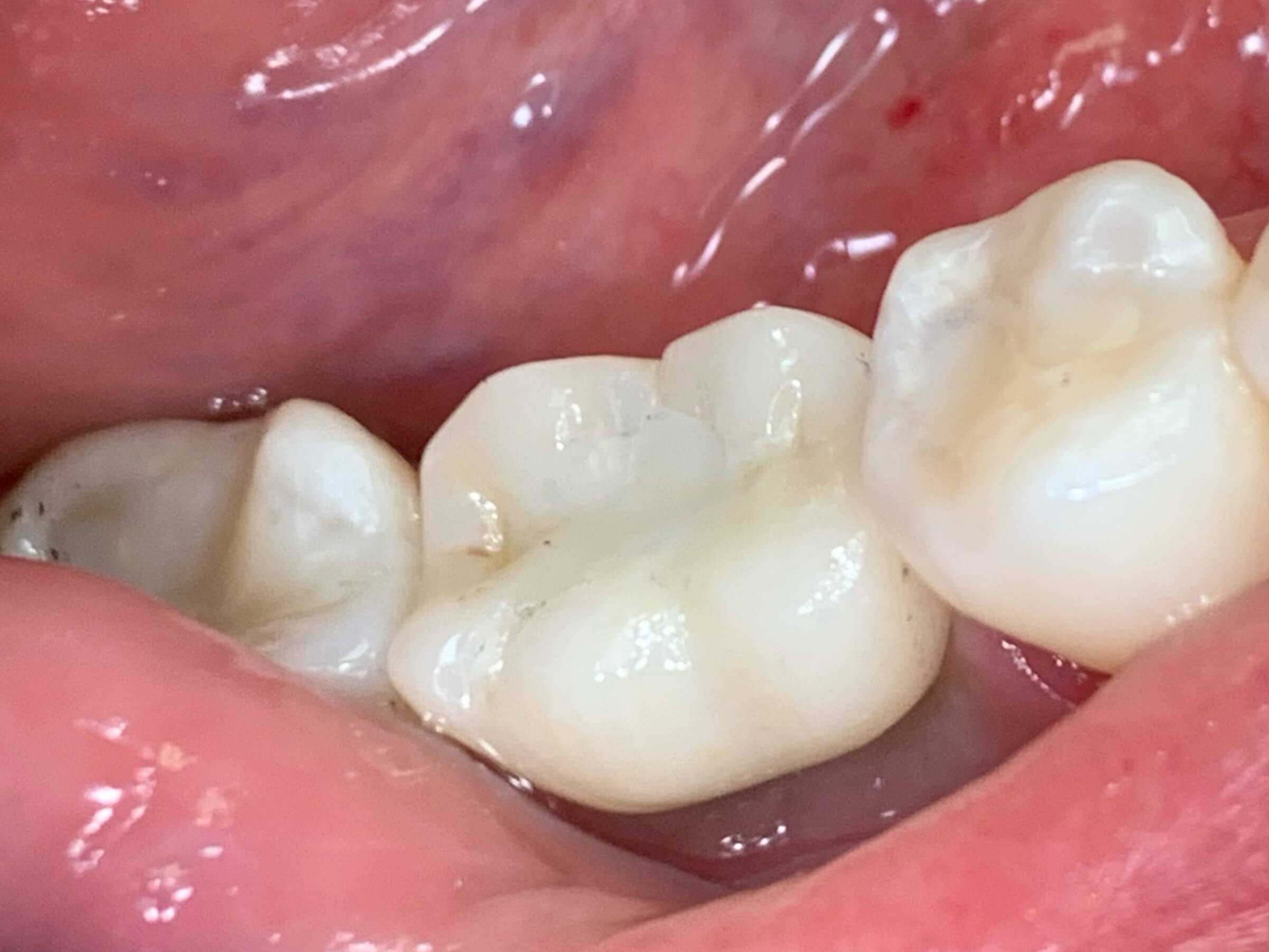 Custom Implant Crown After