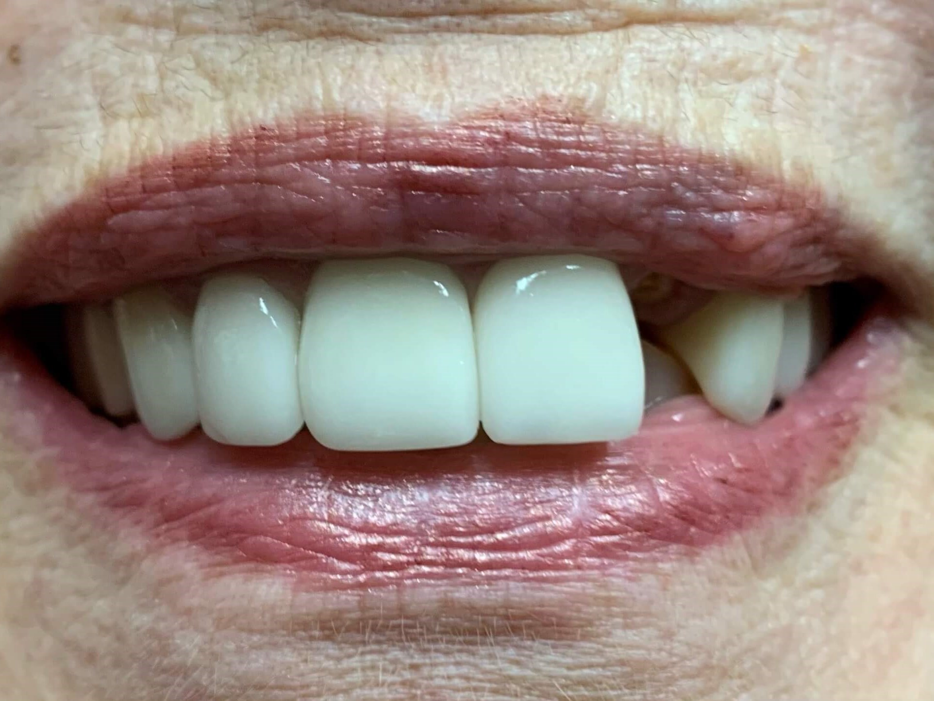 3 Unit Bridge and 3 Crowns Before