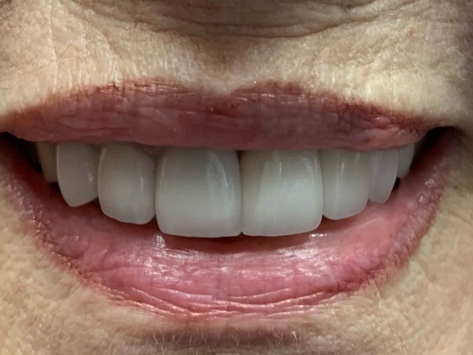 3 Unit Bridge and 3 Crowns After