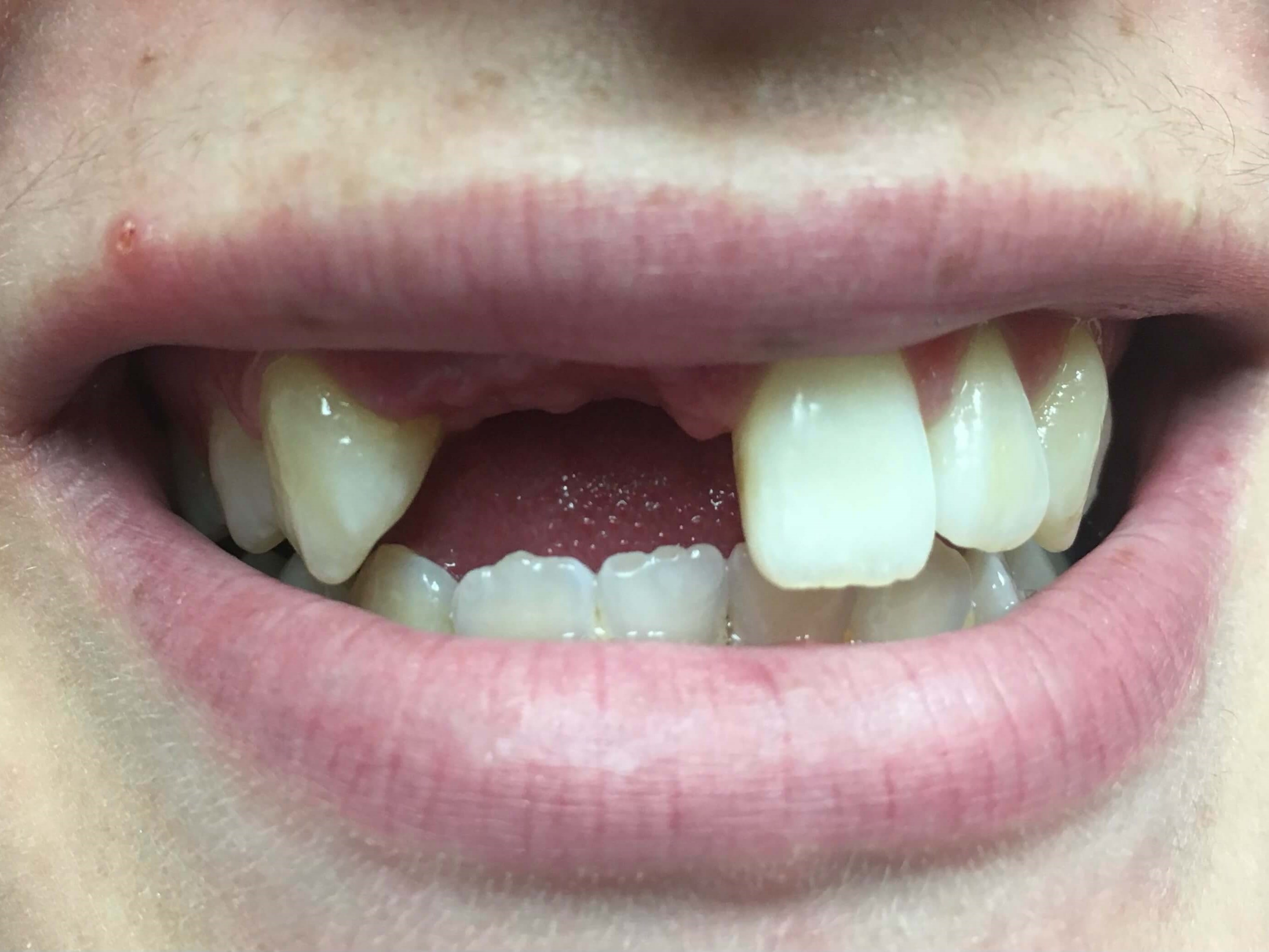 Custom Implant Crowns Before