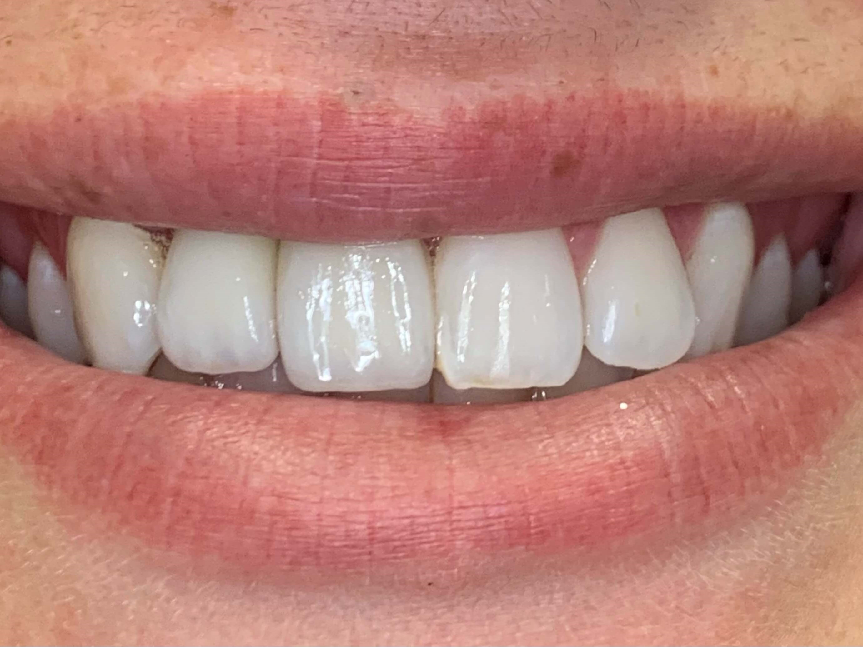 Custom Implant Crowns After