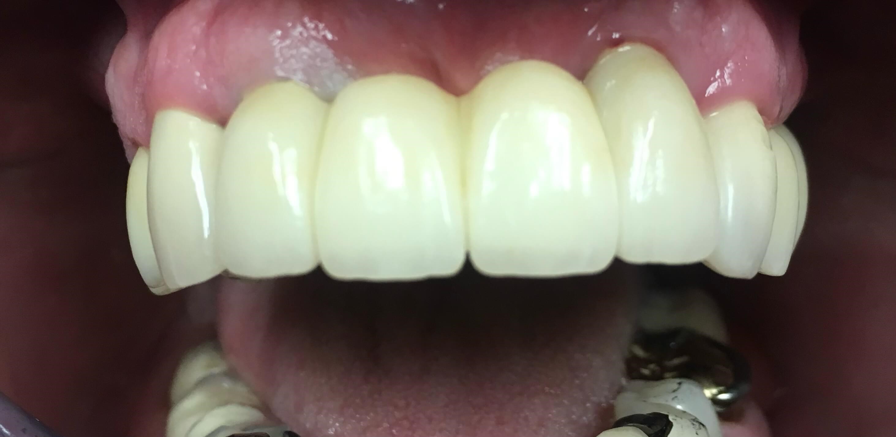 Implant Supported Bridge After