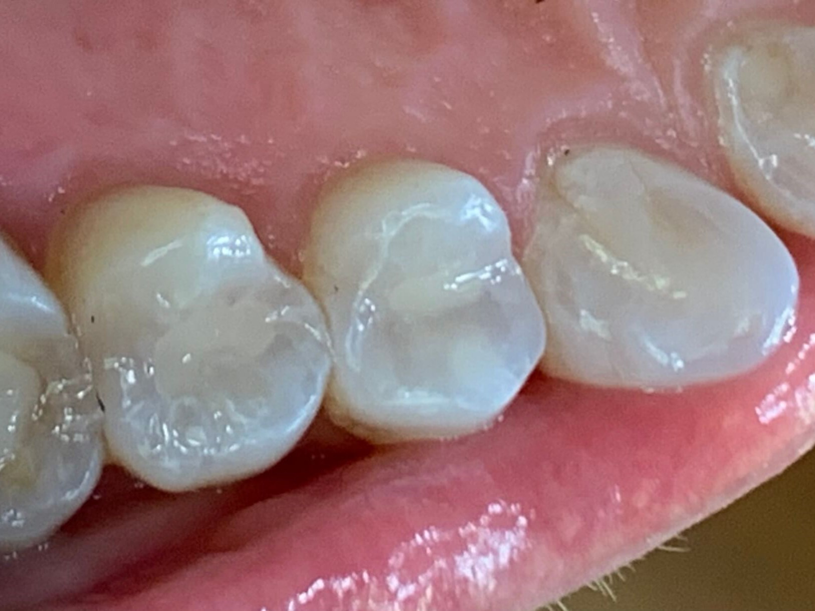 Replacing Composite Fillings After
