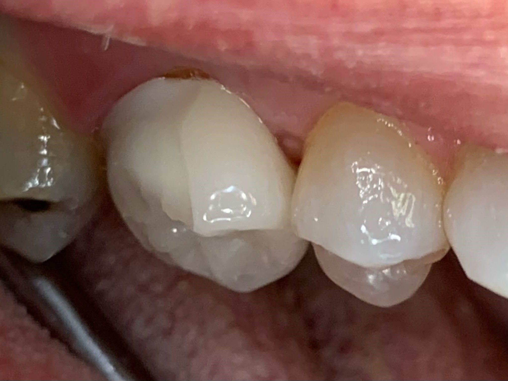 Brand New Crown Before