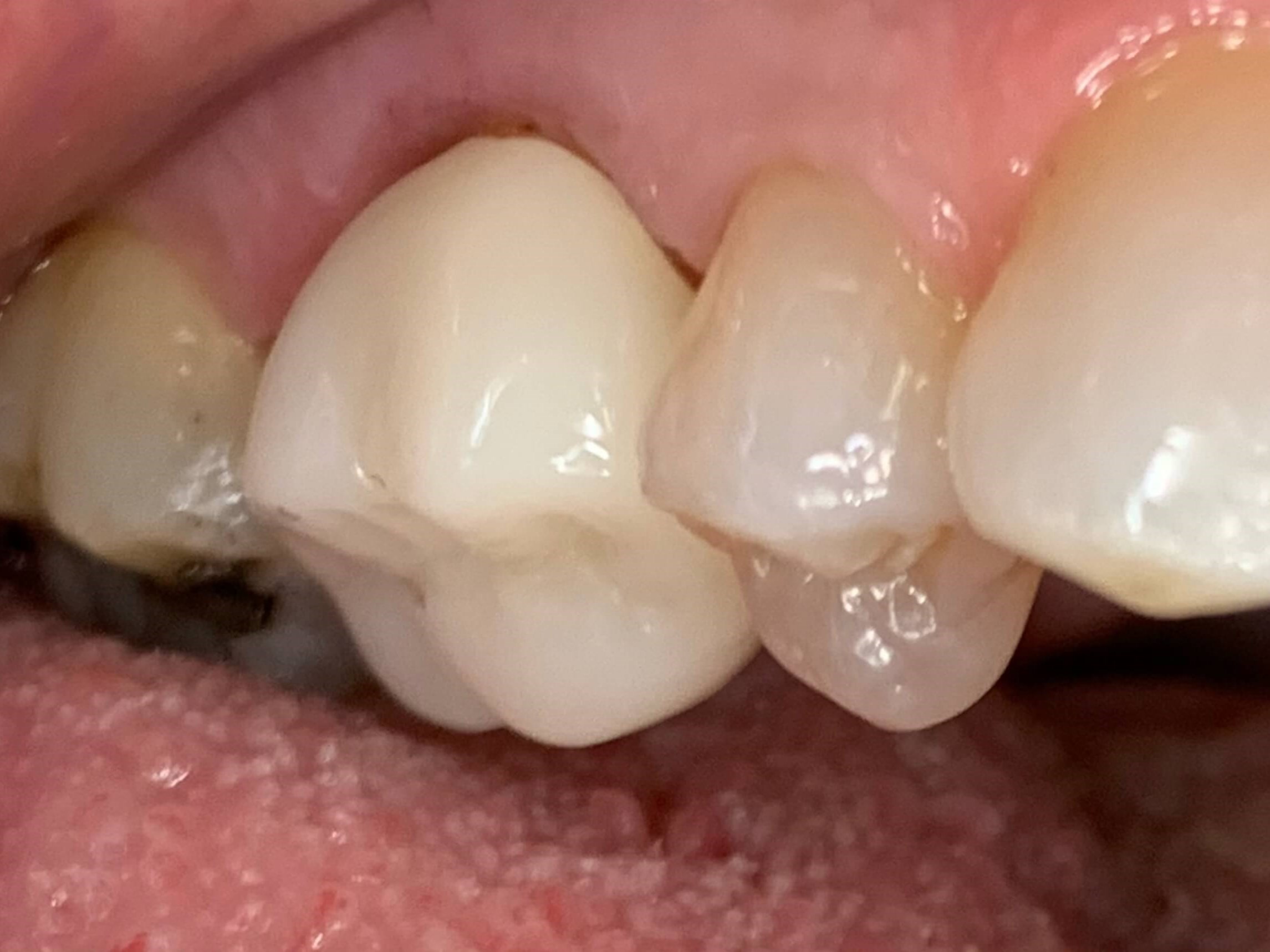 Brand New Crown After