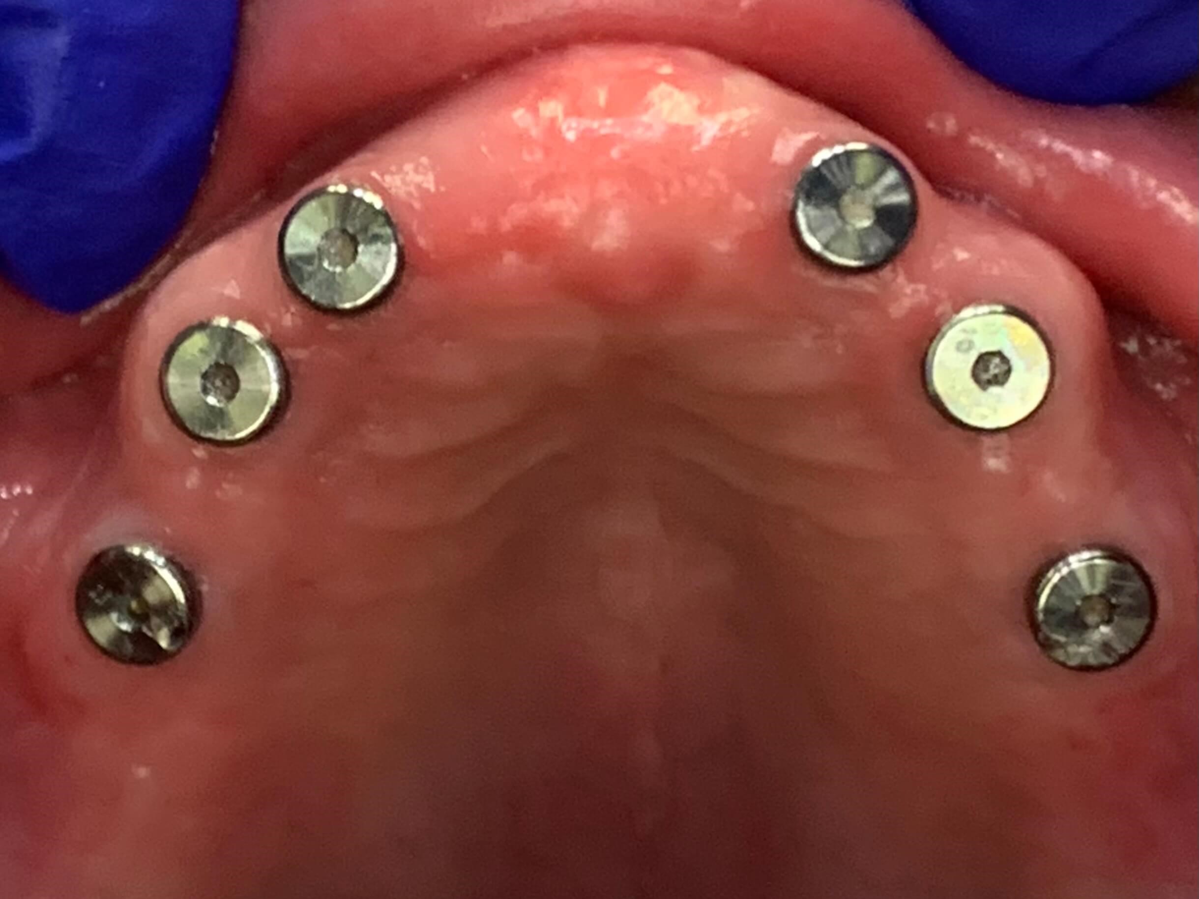 Full Mouth Restoration Before