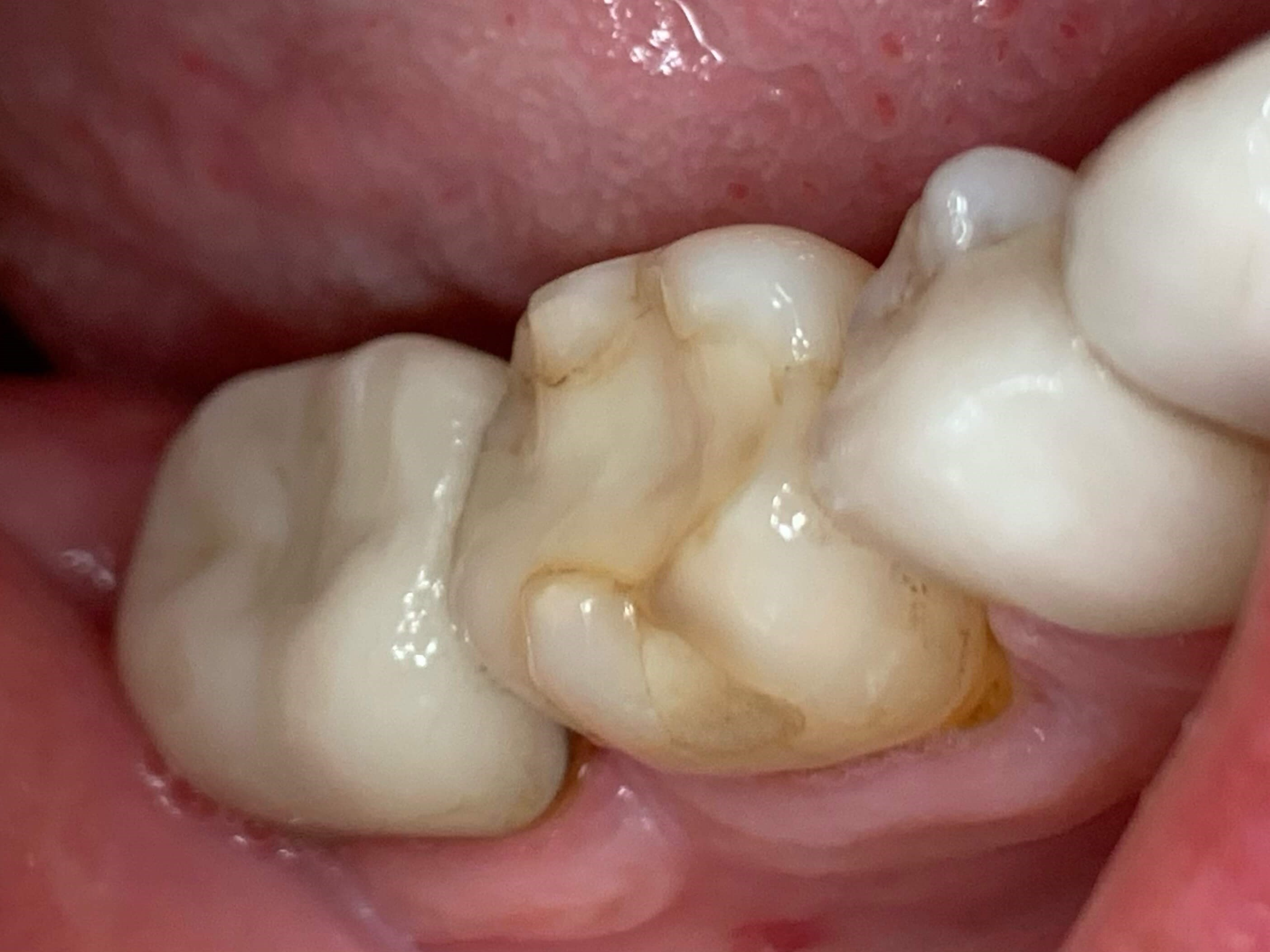 Full Zirconia Crown Before