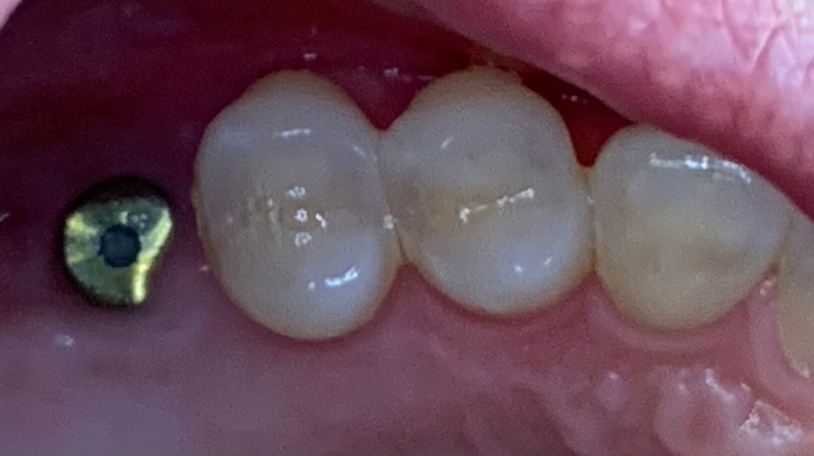 Custom Implant Crown Before