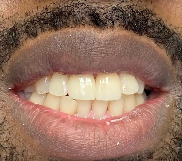 Before & After Photos: Veneers After