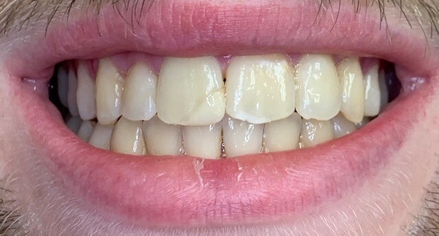 Composite Restoration Before