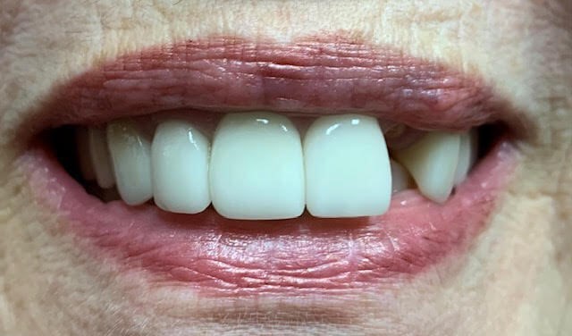 Crowns & Bridge Before