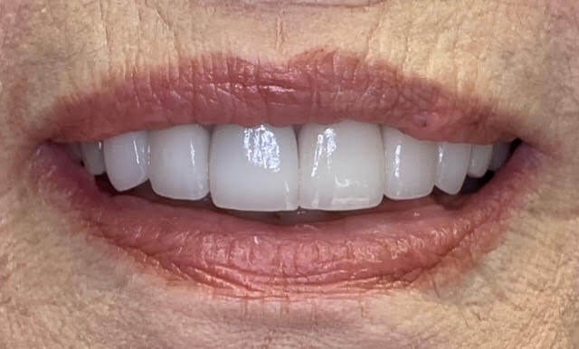 Crowns & Bridge After