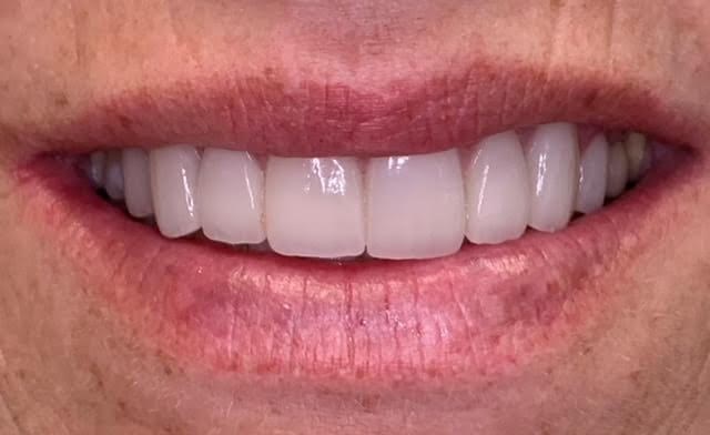 Veneers: Before and After After