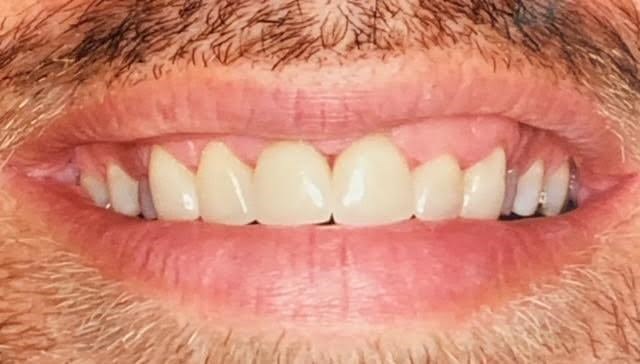 Veneers: Before and After Before