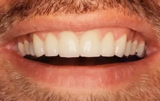 Veneers: Before and After After