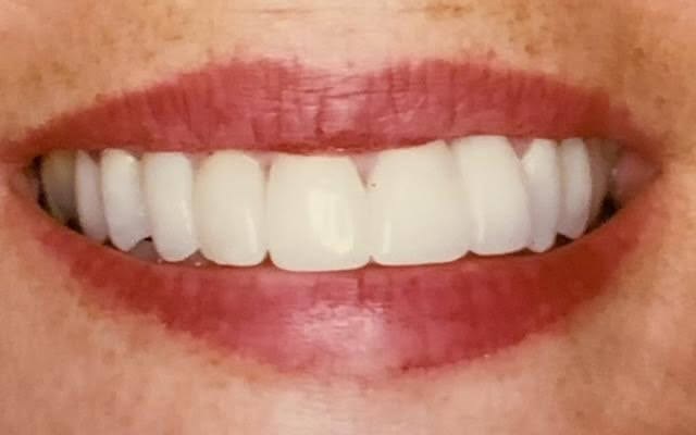 Dental Crowns: Before/After After