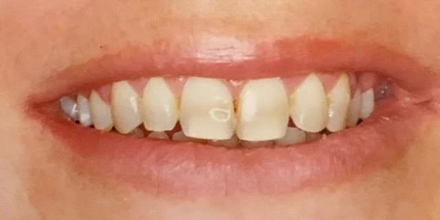 Brighter Smile Before