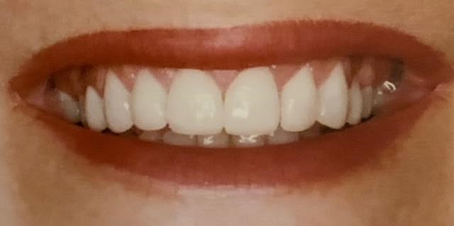 Brighter Smile After