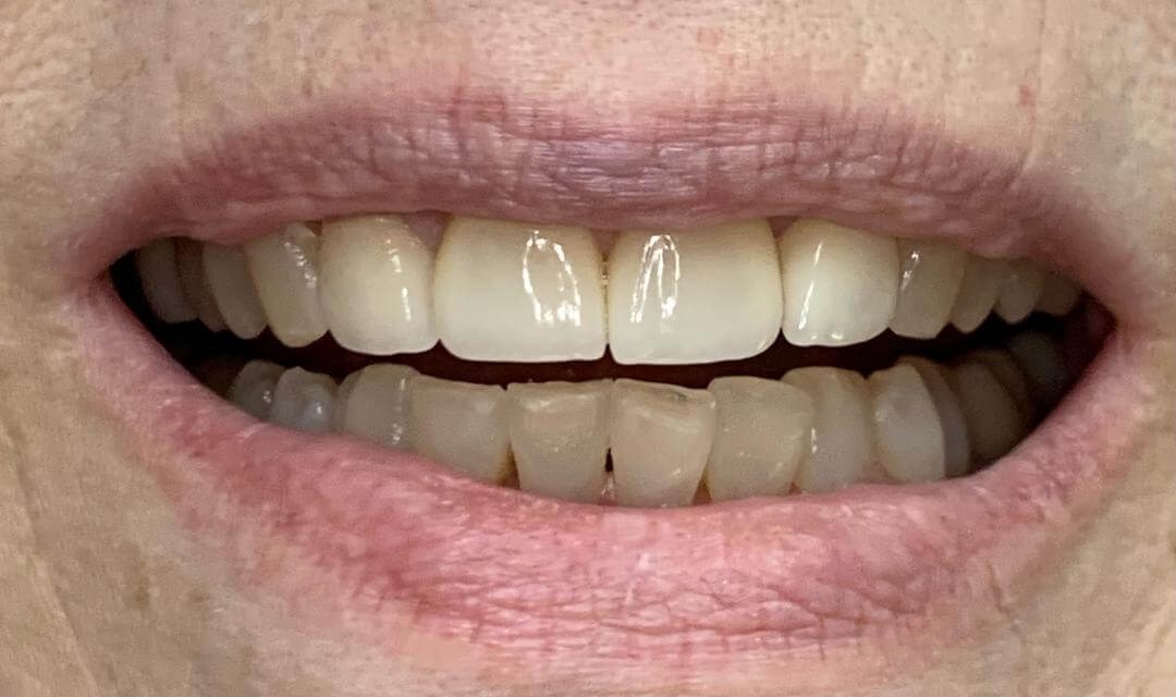 Porcelain Veneers After