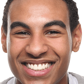 Composite-Resin Fillings