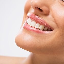 Porcelain Veneers